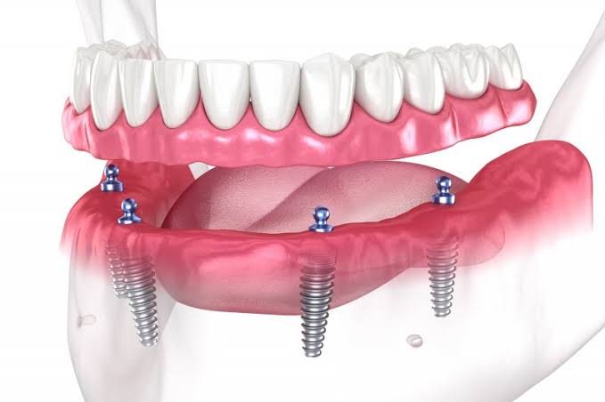 Implants in Agoura Hills