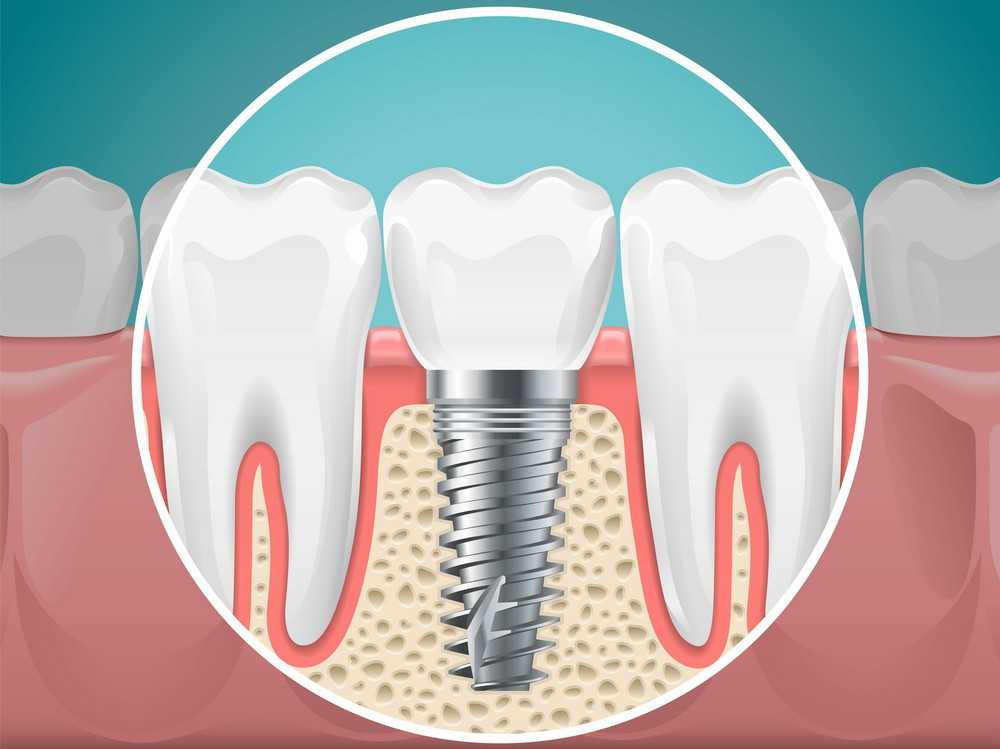 Implant placement