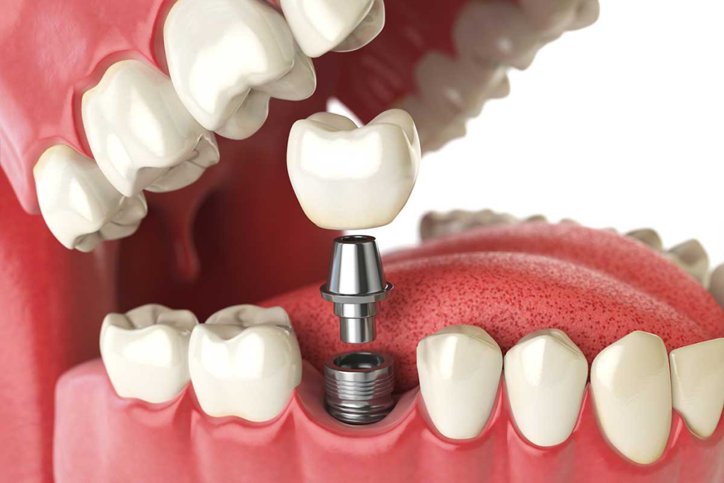 Dental implants in Agoura Hills