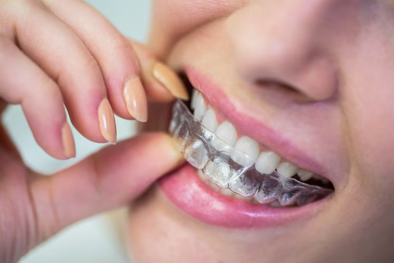 Invisalign Palmdale